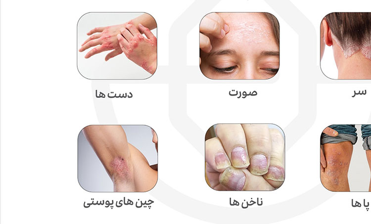 شروع پسوریازیس چگونه است؟